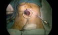 Gastrectomía total laparoscópica