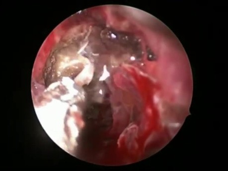 Reparación de fugas de LCR: abordaje endoscópico