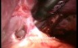 Esplenectomía - abordaje laparoscópico