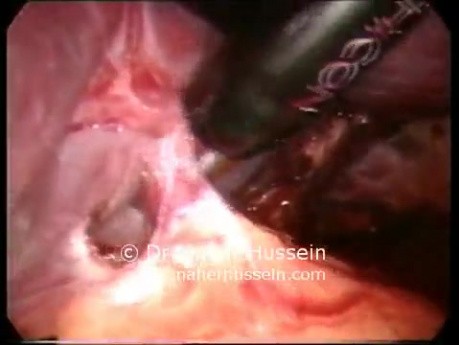 Esplenectomía - abordaje laparoscópico