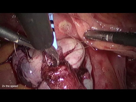 Reimplante laparoscópico del uréter a la vejiga para la estructura endometriótica del uréter