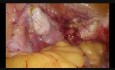 Histerectomía, 2 cesáreas previas