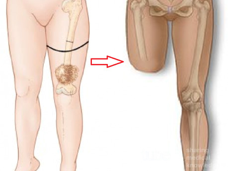 Amputación por encima de la rodilla