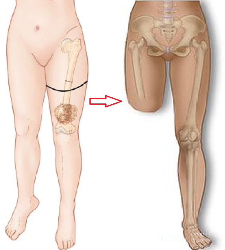 Amputación por encima de la rodilla