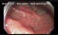 Perforación del colon tras RME - A