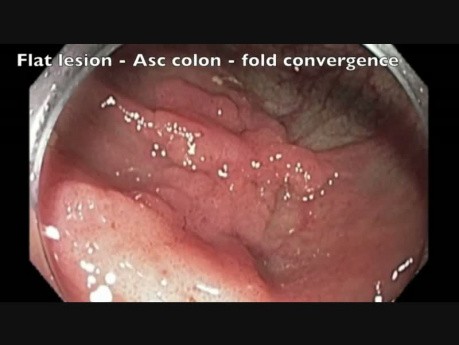 Perforación del colon tras RME - A