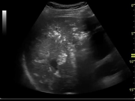 Aerobilia y gas venoso portal: isquemia intestinal segmentaria y neumatosis intestinal