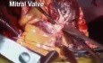 Implantación total de corazón artificial mediante abordaje transauriculoventricular