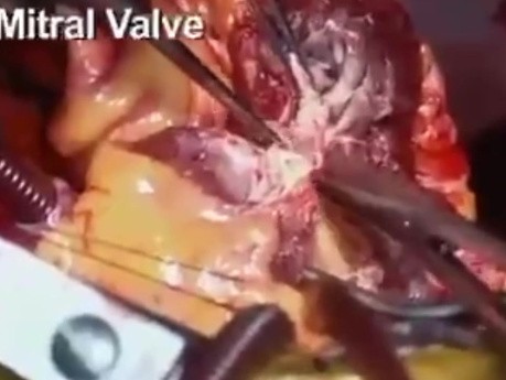 Implantación total de corazón artificial mediante abordaje transauriculoventricular