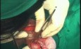 Orquidectomía y orquidepexia por torsión testicular