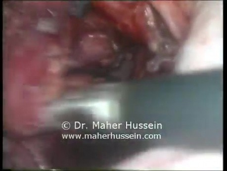 Escisión de tumor perirrectal - abordaje laparoscópico