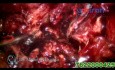Frozen Pelvic Endometriosis Gr-4-Chocolat Cyst