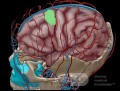 Estirpación de cavernoma subcortical 