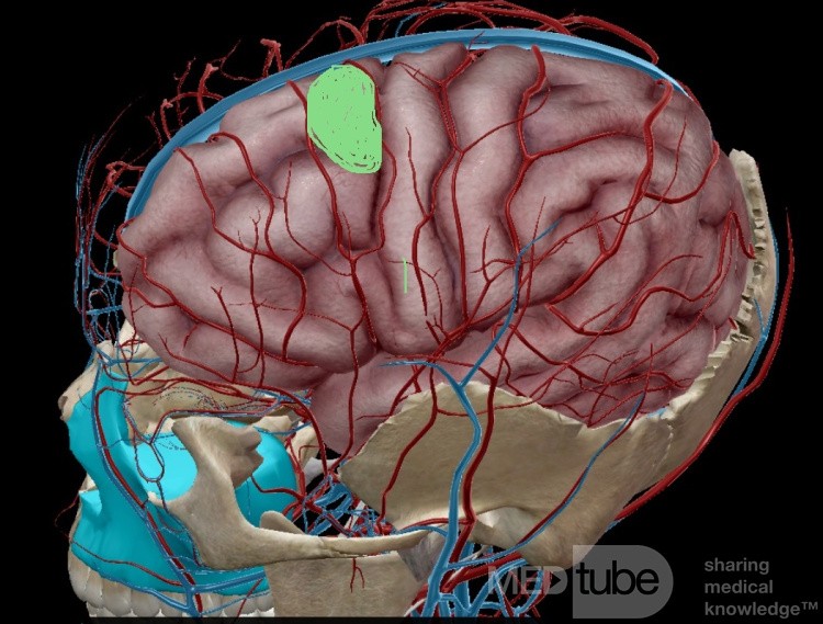 Estirpación de cavernoma subcortical 