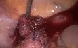 Perforación rectal - sutura laparoscópica