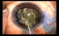 Capsulotomía en un ojo pequeño con el uso de cuchillo de Fugo 