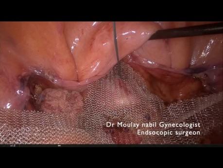 Pectopexia para el prolapso urogenital