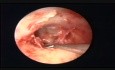 Miringoplastia endoscópica