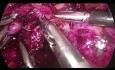 Pancreatectomía distal laparoscópica con preservación de bazo para NQM