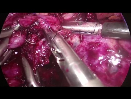 Pancreatectomía distal laparoscópica con preservación de bazo para NQM
