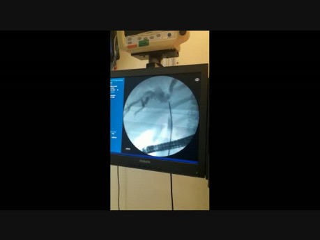 Biopsia directa en frío con fórceps de colangiocarcinoma hiliar bajo fluoroscopia