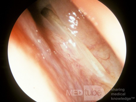 Sinusitis esfenoide