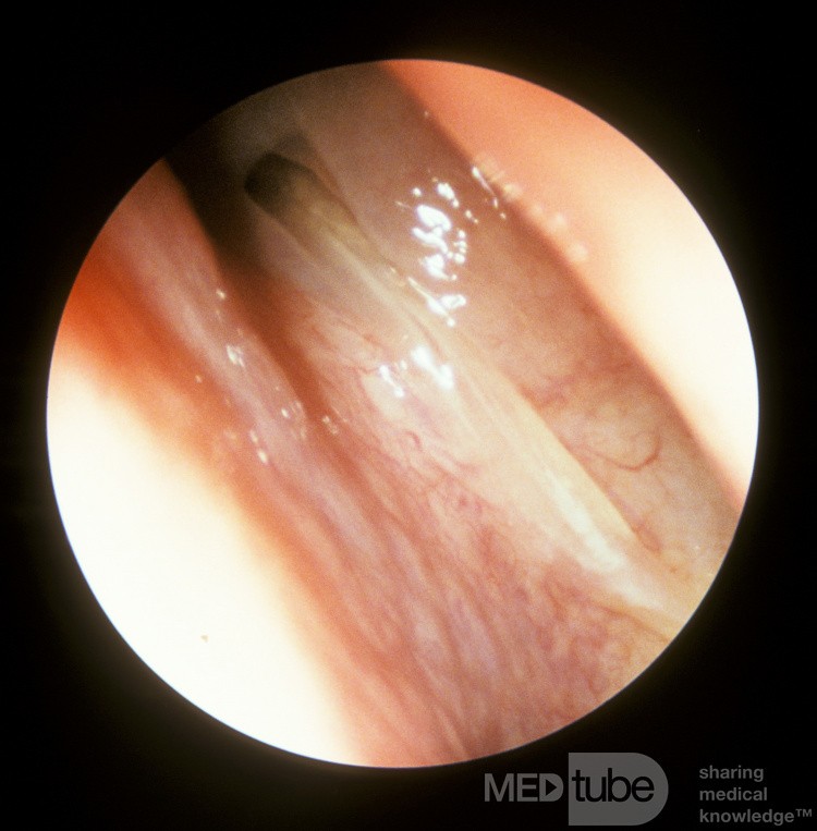 Sinusitis esfenoide