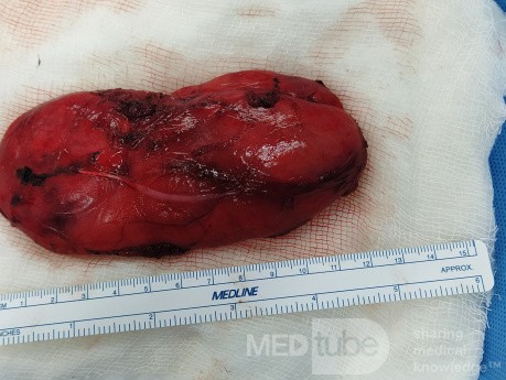 Tumor lipomatoso atípico (liposarcoma diferenciado)