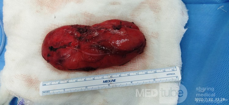 Tumor lipomatoso atípico (liposarcoma diferenciado)