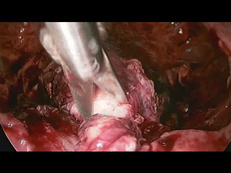 Embarazo ectópico cervical manejado por cirugía laparoscópica
