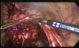 Histerectomía total y adnexectomia bilateral por vía laparoscópica