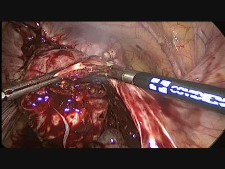 Histerectomía total y adnexectomia bilateral por vía laparoscópica