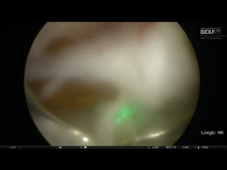 Enucleación endoscópica anatómica de la próstata para la obstrucción prostática benigna - ThuLEP pulsado
