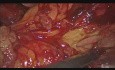Pancreatectomía distal laparoscópica por lesión pancreática  metastásica atípica