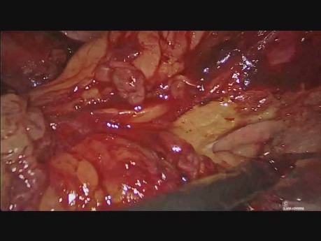 Pancreatectomía distal laparoscópica por lesión pancreática  metastásica atípica