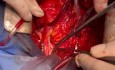 Reconstrucción del tracto de salida del ventrículo derecho con homoinjerto pulmonar