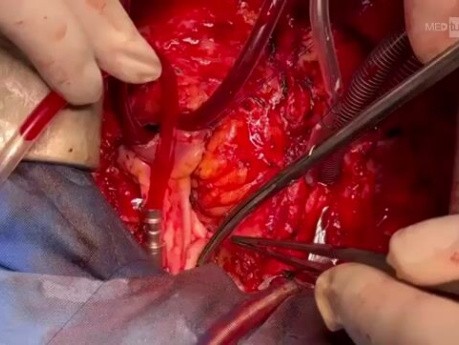 Reconstrucción del tracto de salida del ventrículo derecho con homoinjerto pulmonar