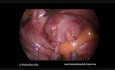 Apendicectomía laparoscópica y anudado intracorpóreo