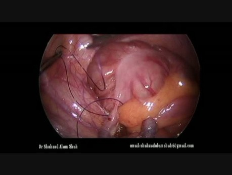 Apendicectomía laparoscópica y anudado intracorpóreo