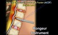 Columna cervical - descompresión y fusión