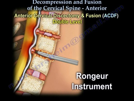 Columna cervical - descompresión y fusión