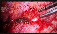 Pleurectomía por videotoracoscopia y resección en cuña del lóbulo superior izquierdo