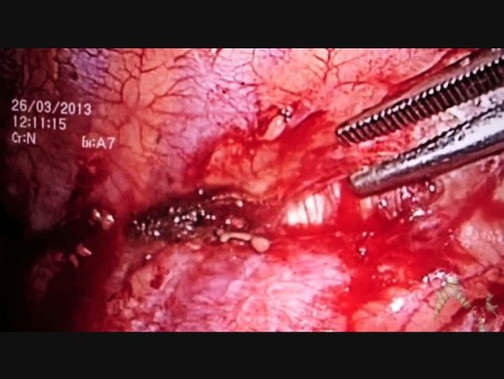 Pleurectomía por videotoracoscopia y resección en cuña del lóbulo superior izquierdo