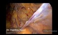 Herniorrafia transabdominal preperitoneal en la hernia inguinal derecha recurrente