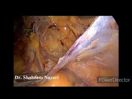 Herniorrafia transabdominal preperitoneal en la hernia inguinal derecha recurrente