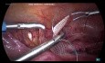Histeropexia laparoscópica para el prolapso apical