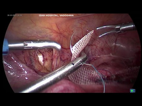 Histeropexia laparoscópica para el prolapso apical