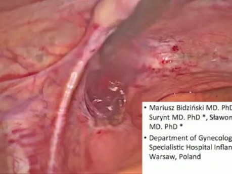 El uso de verde de indocianina en el diagnóstico del ganglio centinela en las neoplasias uterinas - informes preliminares