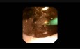 Cirugía retrógrada intrarrenal (RIRS). Piedra ramificada en medio comunicando dos cálices
