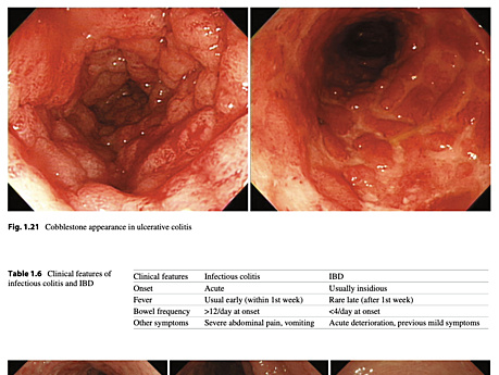 17 Atlas de Enfermedades Inflamatorias Intestinales